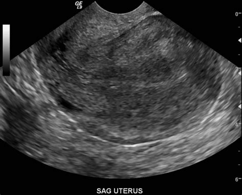 Retroverted Uterus Wikidoc