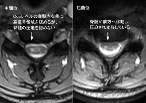Cervical Flexion Myelopathy (平山病)