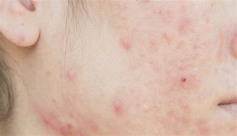 Ciri Fungal Acne Dan Cara Alami Menghilangkannya