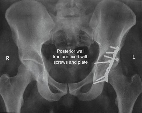 Acetabulum Hip Socket Explained Anatomy 101 For Patients