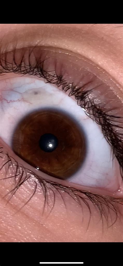 Black Spot In Eye Ball
