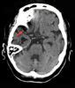 Acute Occlusion Of Middle Cerebral Artery Radiology For Beginners By Dr Samuel Kobba