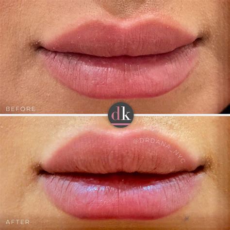 Best Natural Lip Fillers Restylane Silk Lip Fillers Natural Lips