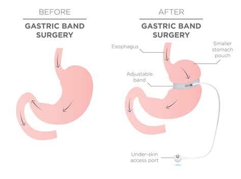 Gastric Band Vs Gastric Sleeve Surgery Lild