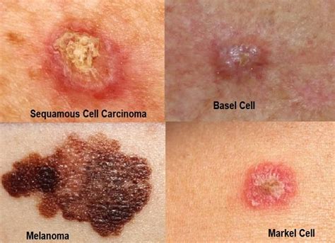 Skin Cancer Types Symptoms Causes And Prevention Vrogue Co