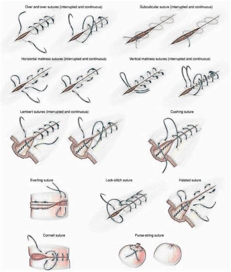 Nurses Notes Understanding Different Types Of Sutures The Nurse