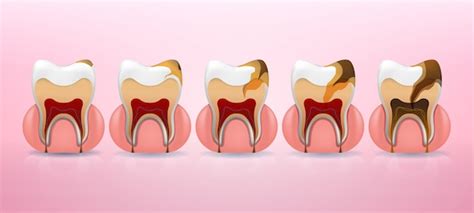 Premium Vector The Stages Of Caries Development