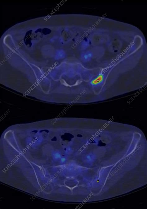 Non Hodgkin Lymphoma Ct Pet Scan Stock Image C0575235 Science