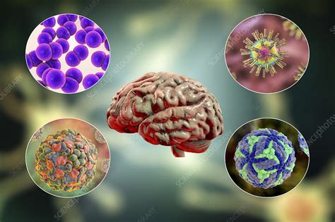 Brain Infections Illustration Stock Image F0304316 Science