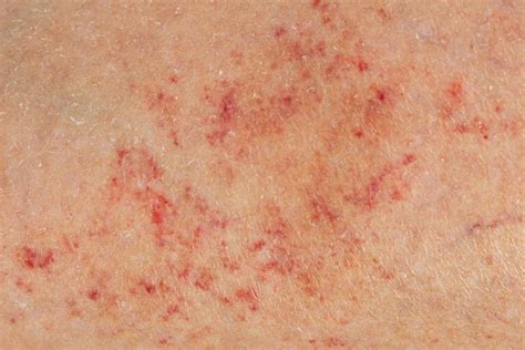 Petechiae Causes Treatment And When To See A Doctor
