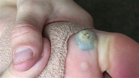 What A Wart Looks Like Hours After Freezing Treatment A Big Blood