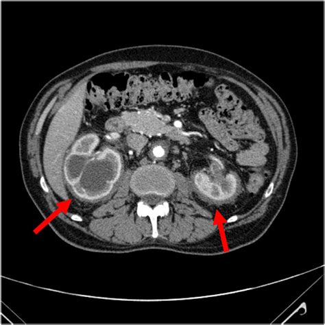 Axial Contrast Enhanced Ct Scan Showed Ureters And Renal Involvement