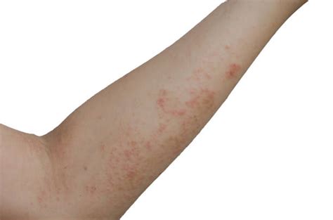 6 Common Skin Rashes And What They Look Like