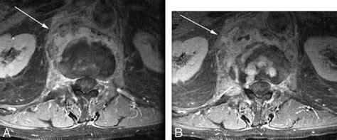 Baseline Postcontrast Fat Saturated Axial T1 Weighted Imaging A