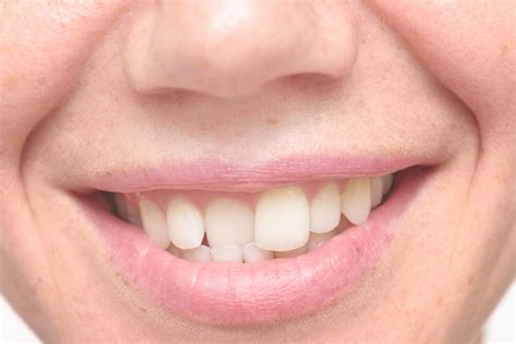 Crooked teeth can be a result of numerous factors, these range from the smallmouth, crowding of teeth, and the difference in the size of lower. Straighten Crooked Teeth Without Braces | Silver Spring MD