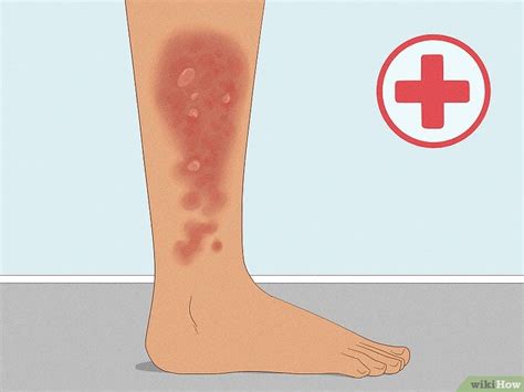 How To Get Rid Of Poison Ivy Rashes Expert Medical Advice