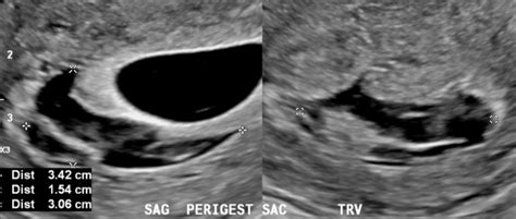 Subchorionic Hemorrhage Sononotes