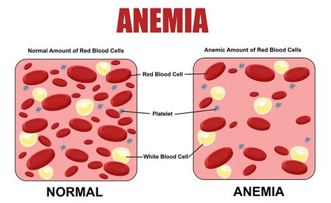 Used in ayurvedic medicine in the treatment of iron deficiency anemia; Causes of Low / High Hemoglobin Levels & How to Normalize ...