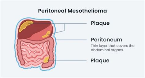 Peritoneal Mesothelioma Causes Symptoms And Treatment Options