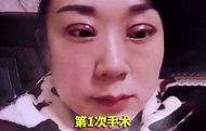 【整容變毀容】割雙眼皮失敗丈夫嫌棄提離婚 大媽哭訴：別人當我怪物一樣 - 香港經濟日報 - TOPick - 健康 - 健康資訊 - D210601