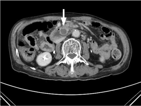 Abdominal Ct Finding Asymmetric Thickening Of The Bowe Open I