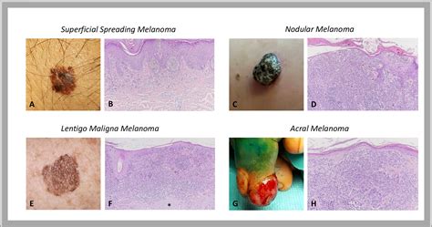 Melanoma Histology