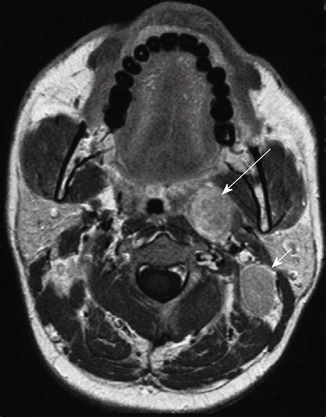 Magnetic Resonance Imaging Staging Of Nasopharyngeal Carcinoma In The