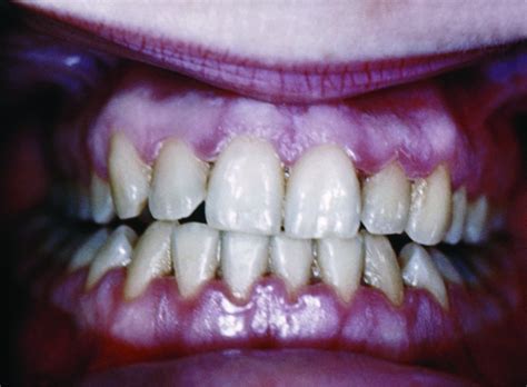 White Lines On Teeth By Gums Teethwalls