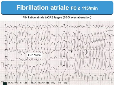 Fibrillation Atriale 2 Ecg E Cardiogram