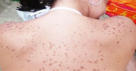 Brown Spots Brown Spots On Skin And Spots On Skin On Pinterest