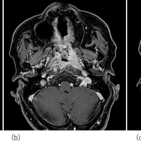 Magnetic Resonance Images Of Nasopharyngeal Squamous Cell Carcinoma In