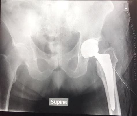 Modified Direct Lateral Approach Total Hip Arthroplasty With Good