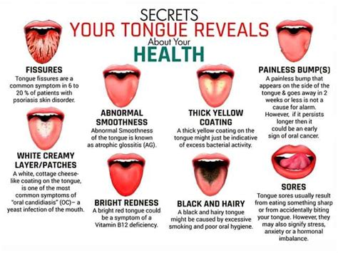 Oral Medicine What Is Your Tongue Trying To Tell You About Your