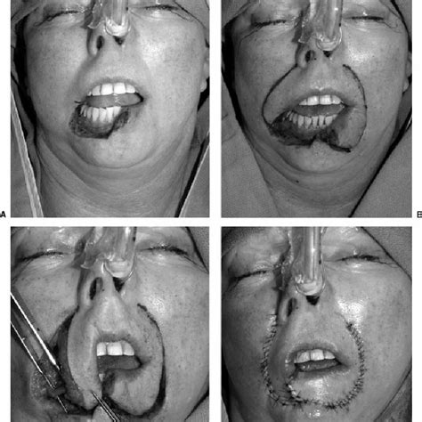 Recurrent Squamous Cell Carcinoma Of Nasal Vestibule And Upper Lip