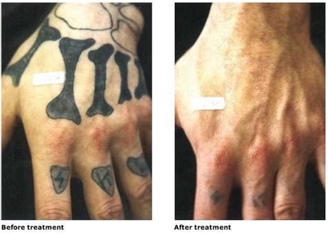 Erase Tattoo Removal Great Before And After Tattoo Removal Results