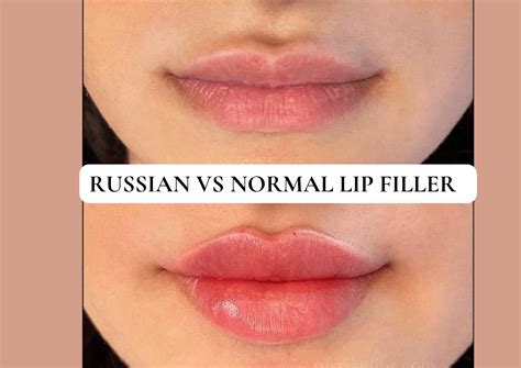 Russian Lip Filler Technique Vs Normal Whats The Difference The