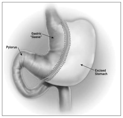Complications Associated With Laparoscopic Sleeve Gastrectomy For