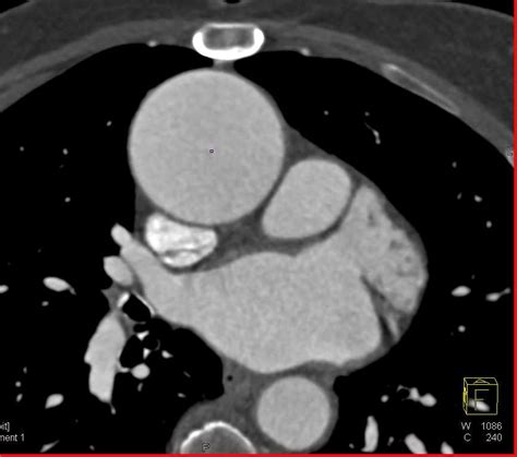 Aortic Valve Replacement With Dilated Ascending Aorta Chest Case