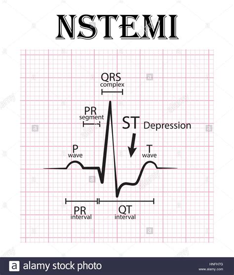 Activate cath lab for patients with stemi on prehospital ecg even if st elevation has resolved by time of arrival at. ECG nicht ST Höhe Myokardinfarkt (NSTEMI) und EKG (P-Welle ...