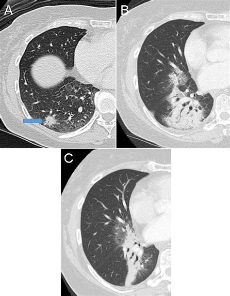 Southwest Journal Of Pulmonary Critical Care And Sleep Imaging