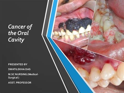 Cancer Of Oral Cavity Easy Explanation For Nurses
