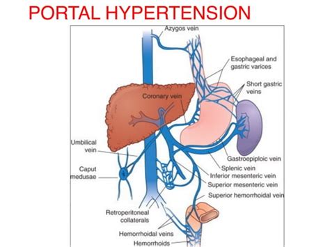 Portal Hypertension Ppt