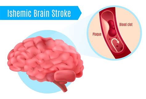 A stroke occurs when part of the brain loses its blood supply and stops working. Ischemic Stroke Treatment | RD Global