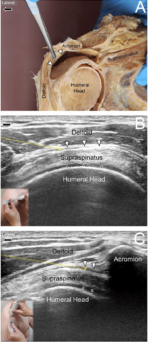 Shoulder Ultrasound Anatomy