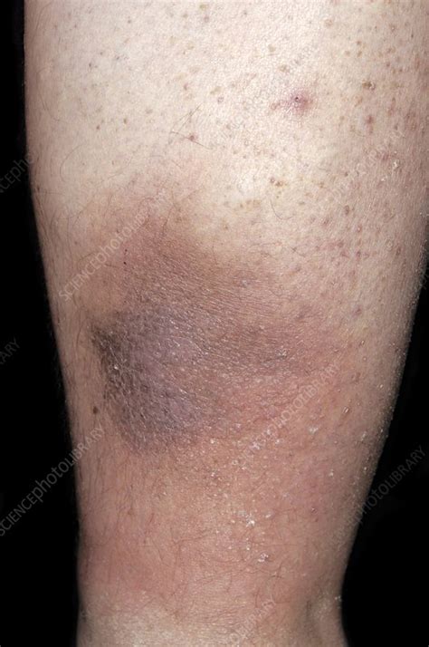 Pigmentation In The Lower Leg Stock Image C0024783 Science Photo