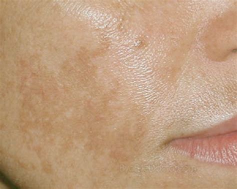 Brown Spots On Face Pictures Causes Prevention