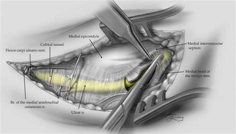 Ulnar Nerve Decompression At The Elbow Kaitlin Lindsay