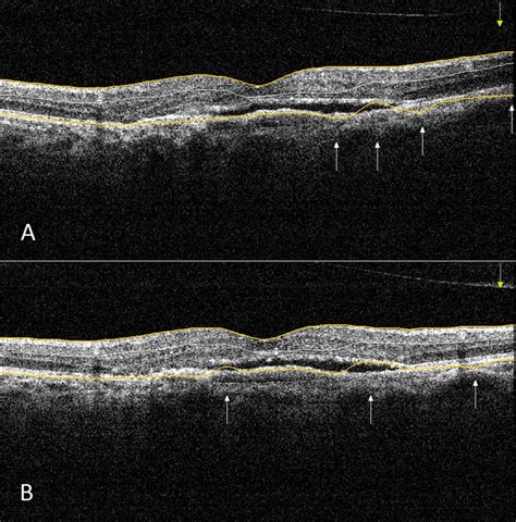 Macular Oct Scan Of A Subject With Age Related Macular Degeneration
