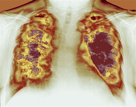 Loss Of Lung Tissue X Ray Photograph By Du Cane Medical Imaging Ltd