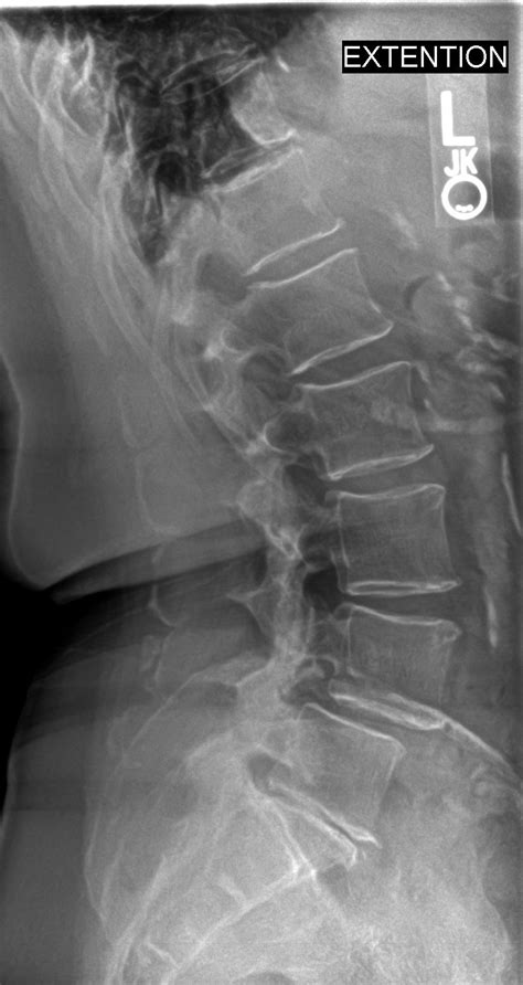 Learn how the procedure is performed and if there are any safety risks. Spondylolisthesis: Everything you ever wanted to know, and ...